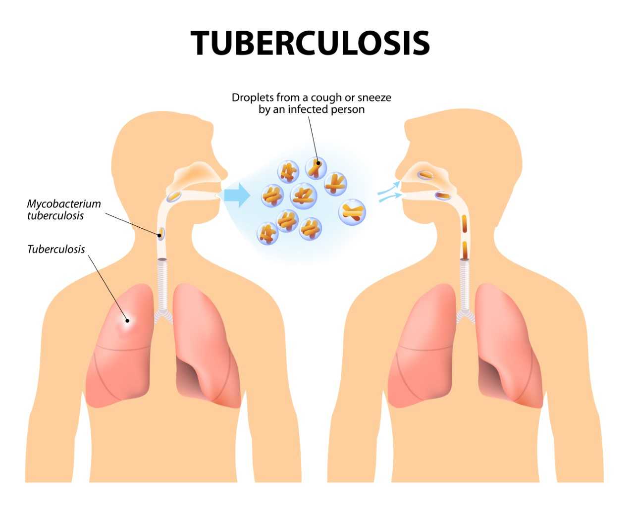 Tuberculosis and Lung Infection