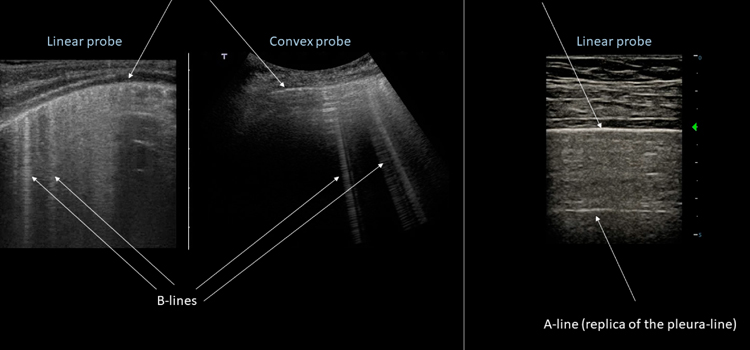 Ultrasound Thorax